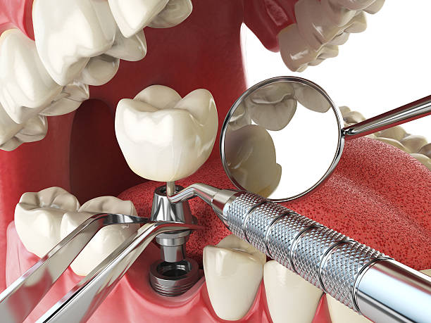 Best Broken or Chipped Tooth Repair in Felida, WA